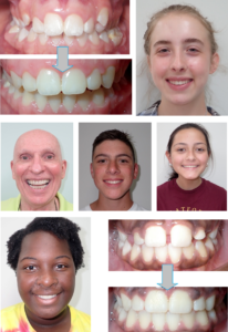 Photo of teeth in treatment