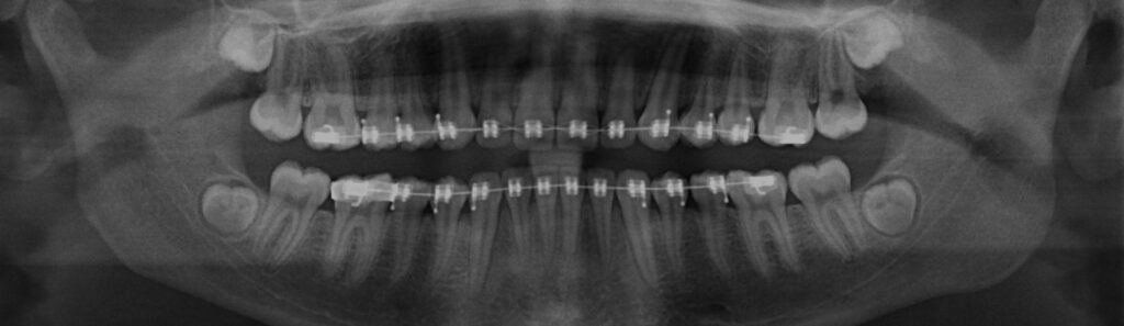 X-Ray of teeth and braces