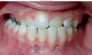 Photo of a Partial Anterior Crossbite