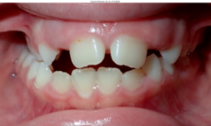 Photo of a Posterior Crossbite