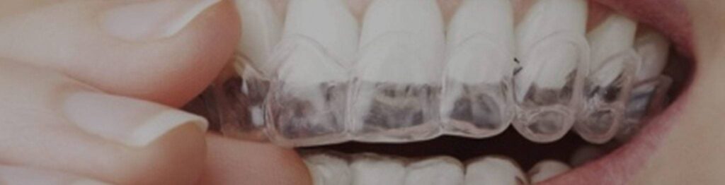 Photo of a retainer