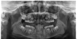 X-Ray of Severe Crowding