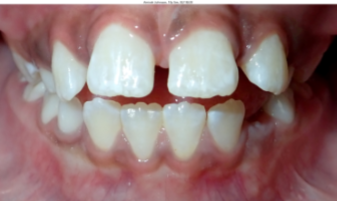 Photo of Thumb or Finger Habit