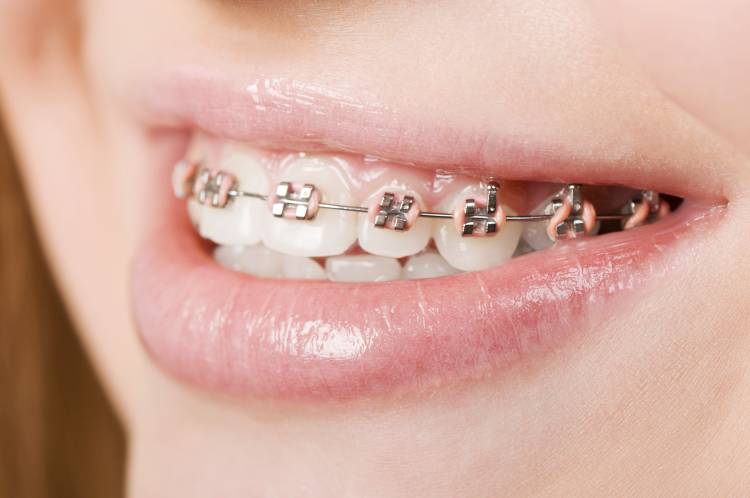 Photo of traditional braces.