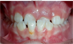 Photo of an underbite