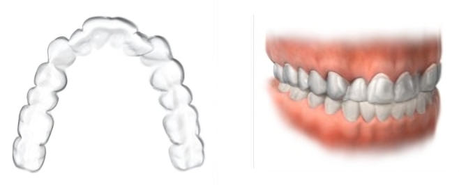 Clear Aligners